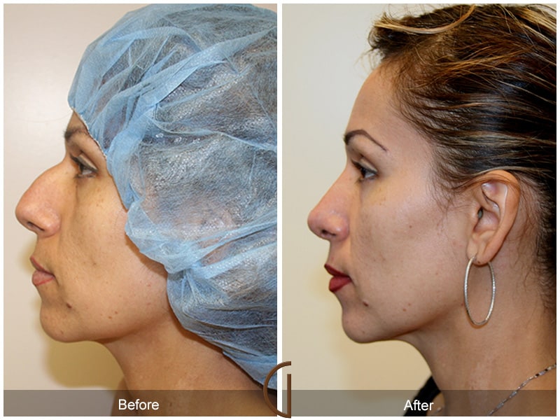 Ethnic Rhinoplasty Orange County CA 13 Image