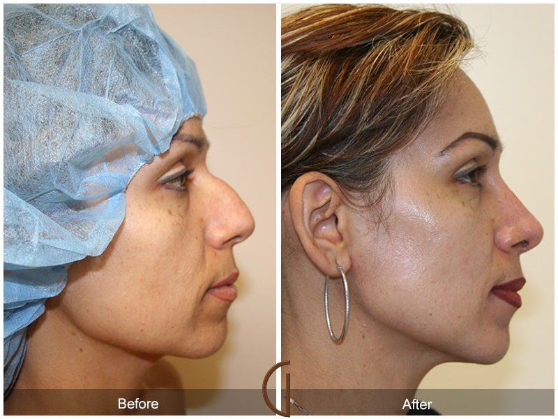 Ethnic Rhinoplasty Orange County CA 13 Image