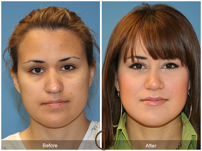 Ethnic Rhinoplasty Coto de Caza CA 17 Image