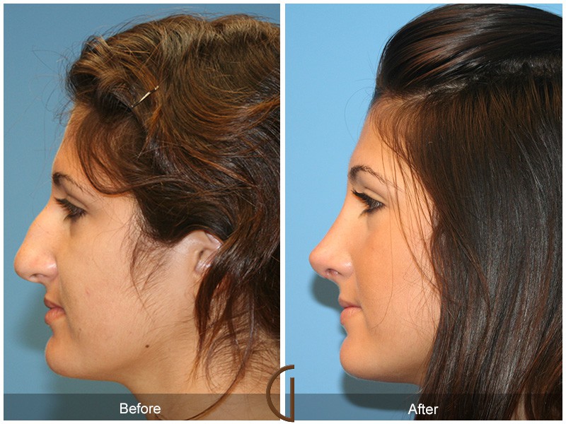 Ethnic Rhinoplasty Villa Park CA 24 Image