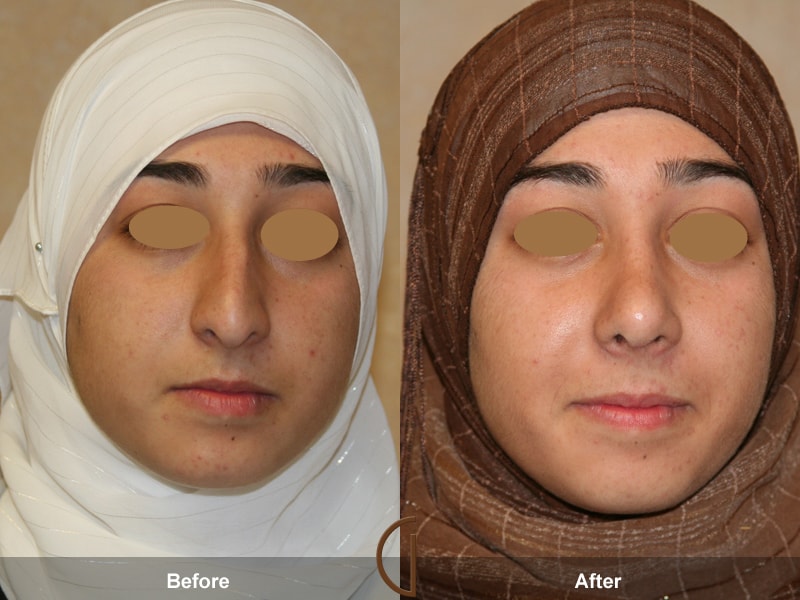 Ethnic Rhinoplasty North Tustin CA 26 Image