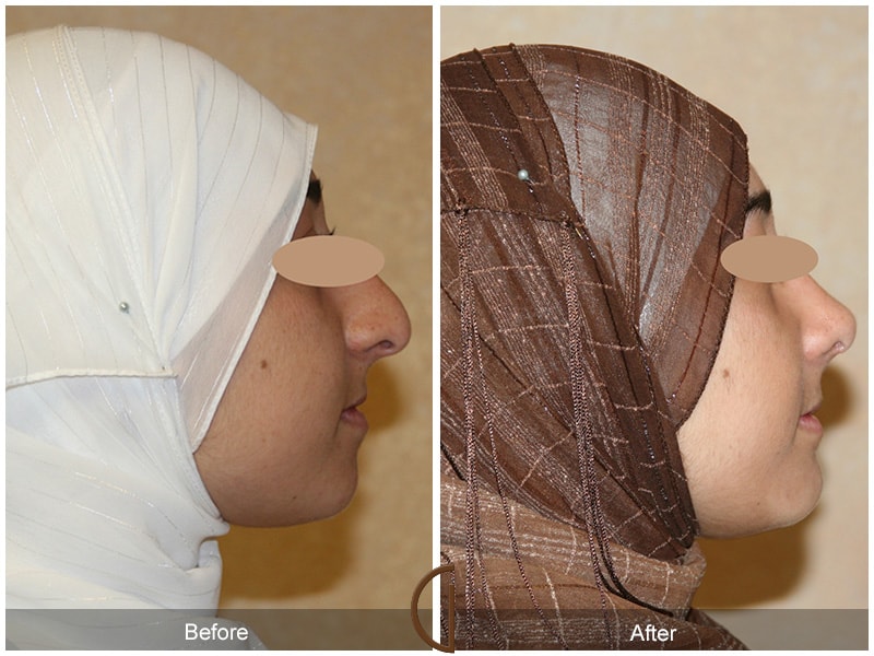 Ethnic Rhinoplasty North Tustin CA 26 Image