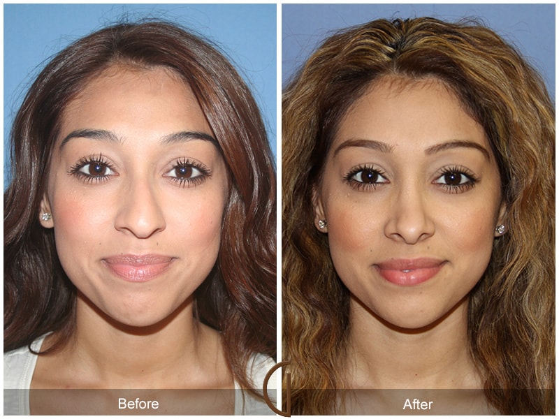 Ethnic Rhinoplasty Yorba Linda CA 47 Image