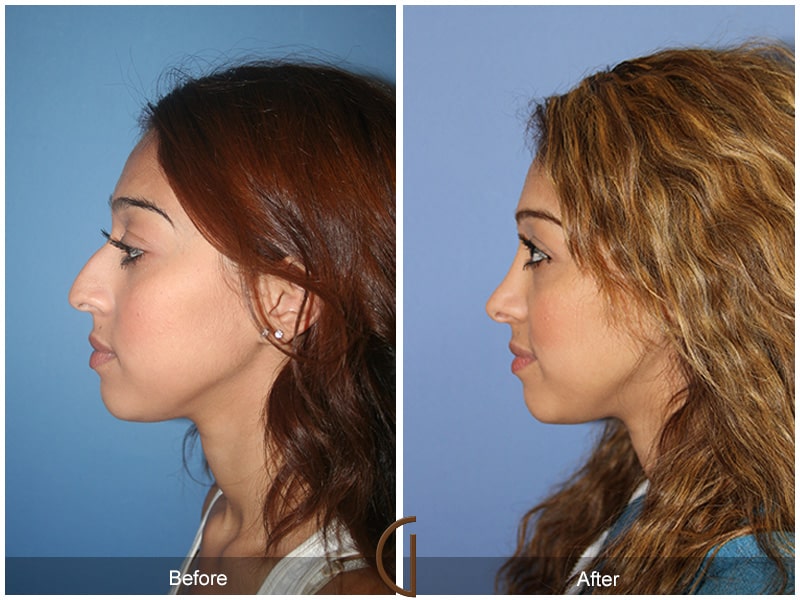Ethnic Rhinoplasty Yorba Linda CA 47 Image