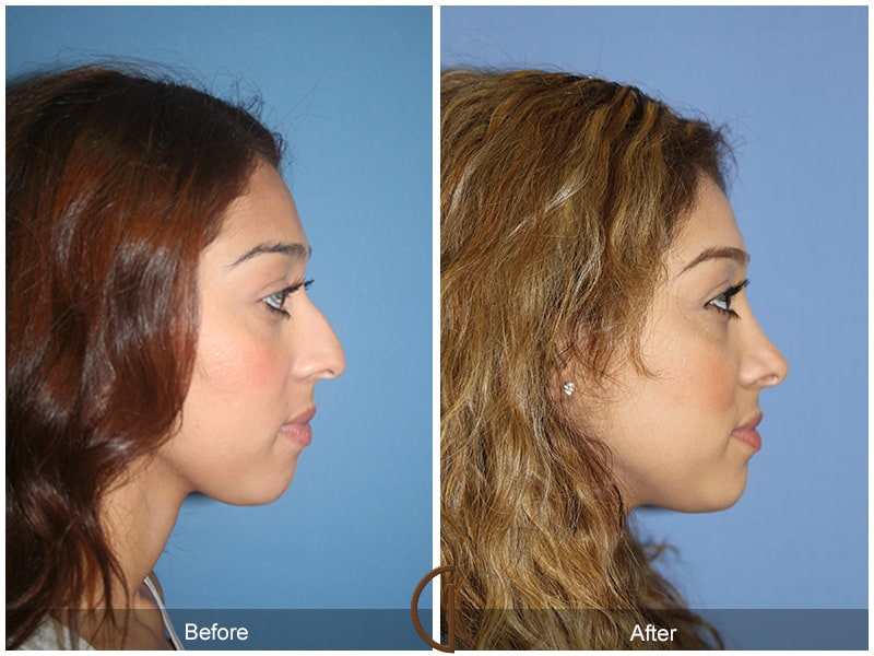 Ethnic Rhinoplasty Yorba Linda CA 47 Image