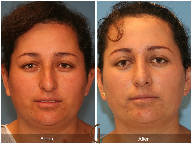 Ethnic Rhinoplasty Newport Beach CA 69 Image