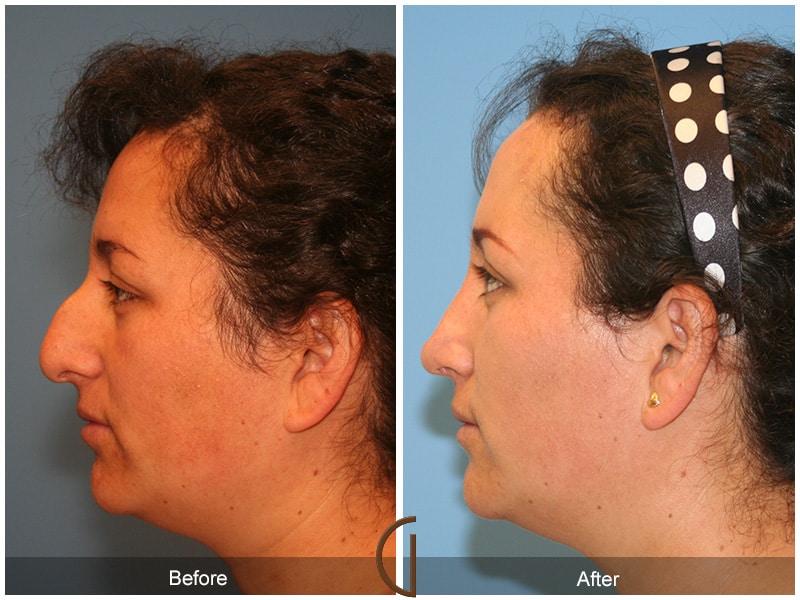 Ethnic Rhinoplasty Newport Beach CA 69 Image