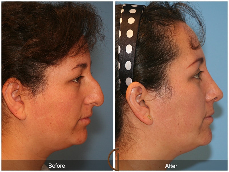 Ethnic Rhinoplasty Newport Beach CA 69 Image