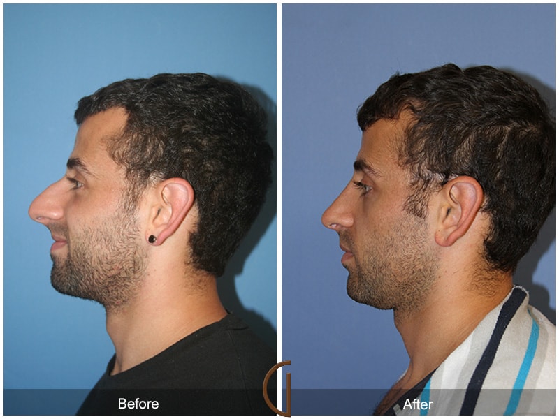 Ethnic Rhinoplasty Aliso Viejo CA 78 Image
