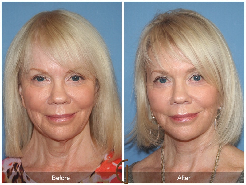 Facelift Orange County CA 1 Image