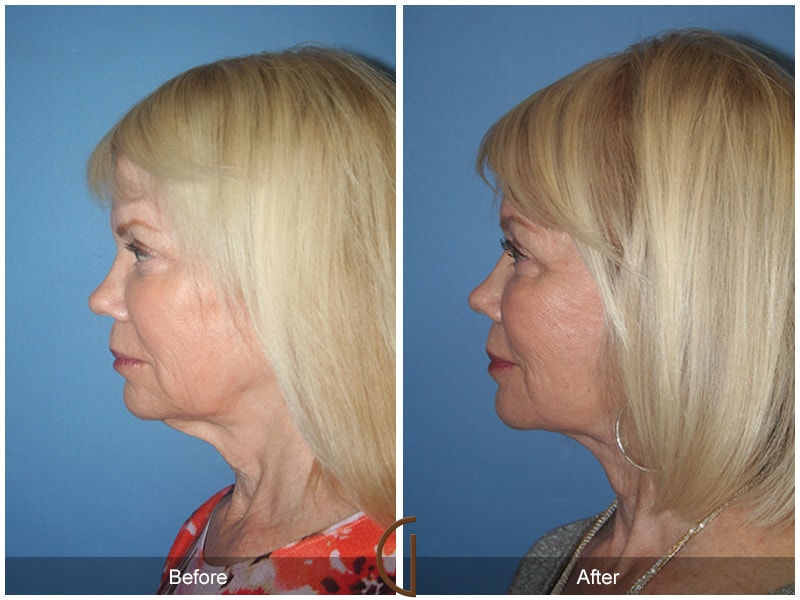 Facelift Orange County CA 1 Image