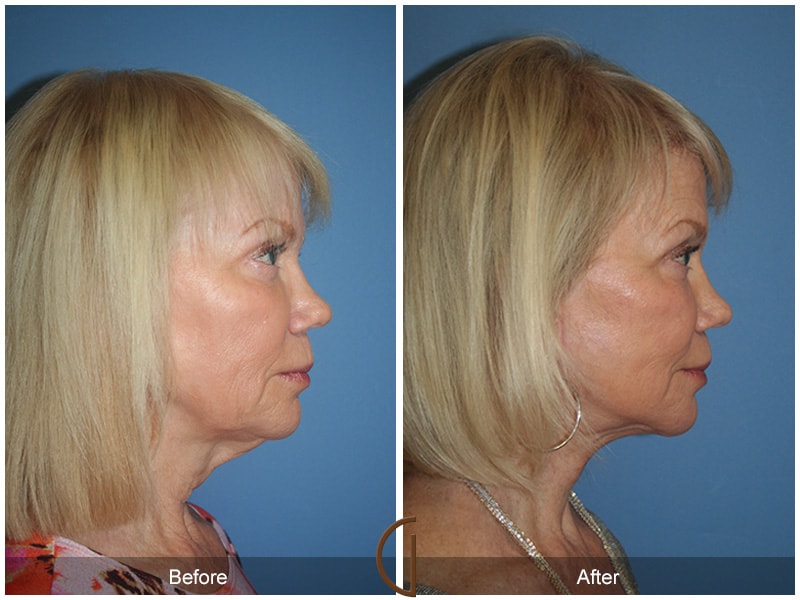 Facelift Orange County CA 1 Image