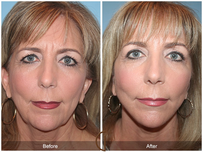 Facelift Ladera Ranch CA 101 Image