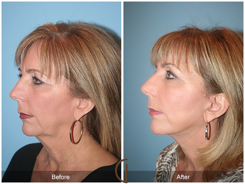 Facelift Ladera Ranch CA 101 Image
