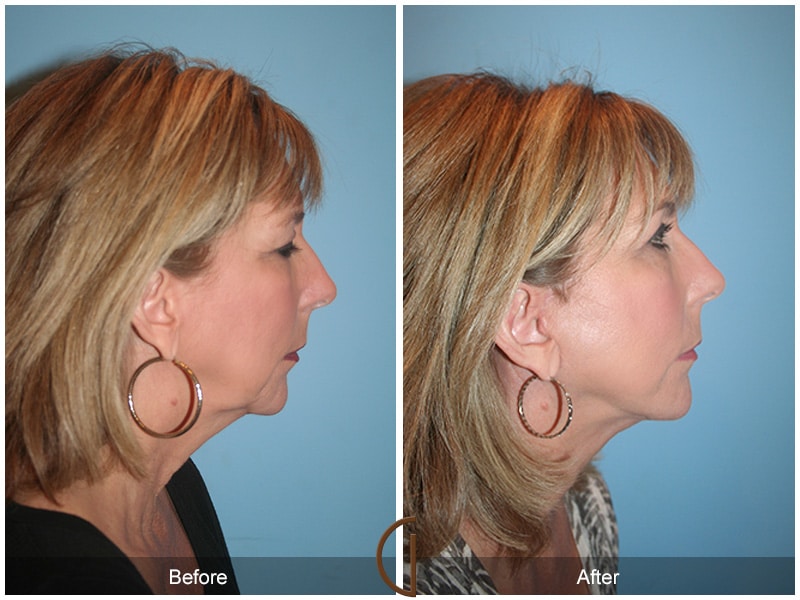 Facelift Ladera Ranch CA 101 Image