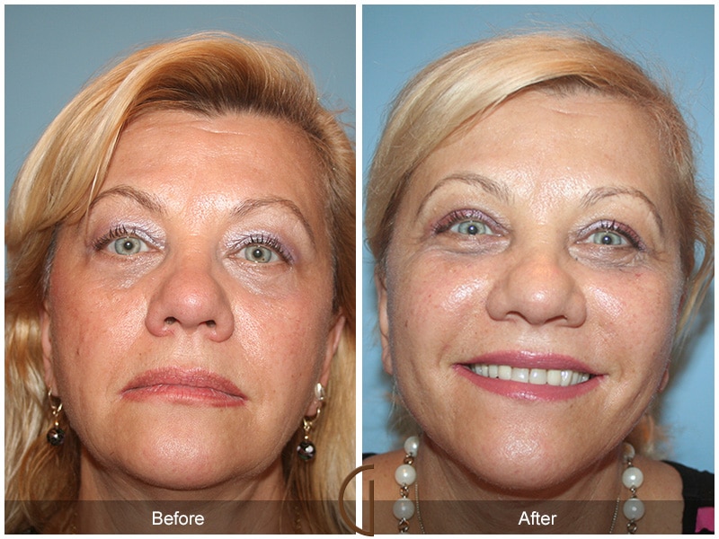 Facelift Yorba Linda CA 104 Image