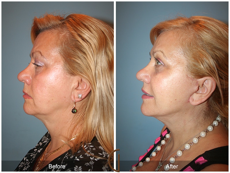Facelift Yorba Linda CA 104 Image