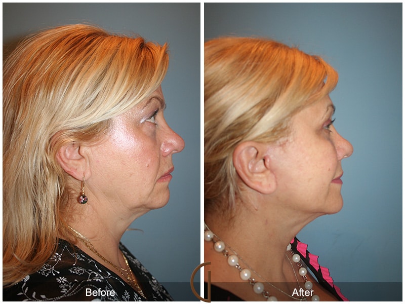Facelift Yorba Linda CA 104 Image