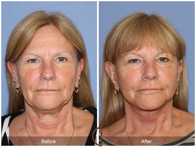Facelift Rossmoor CA 105 Image