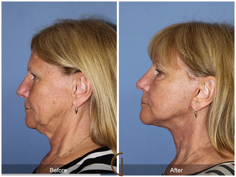 Facelift Rossmoor CA 105 Image