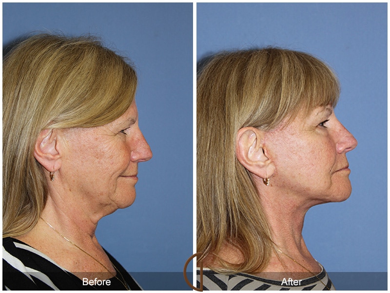 Facelift Rossmoor CA 105 Image