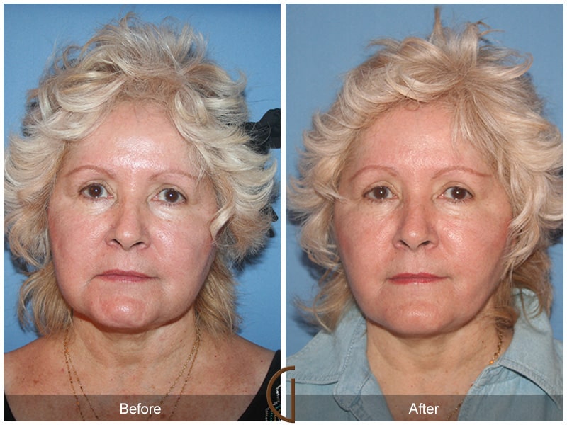 Facelift Newport Beach CA 106 Image