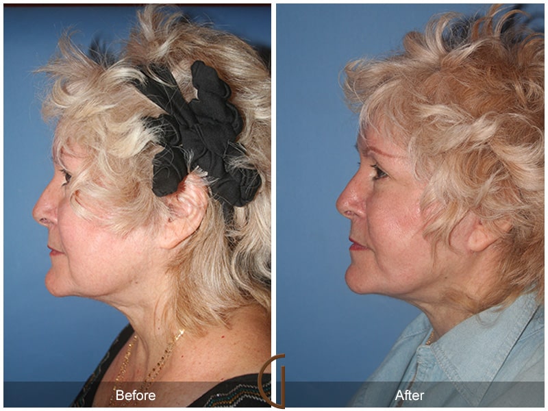 Facelift Newport Beach CA 106 Image