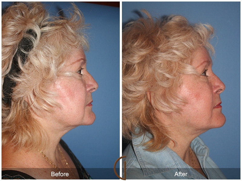 Facelift Newport Beach CA 106 Image