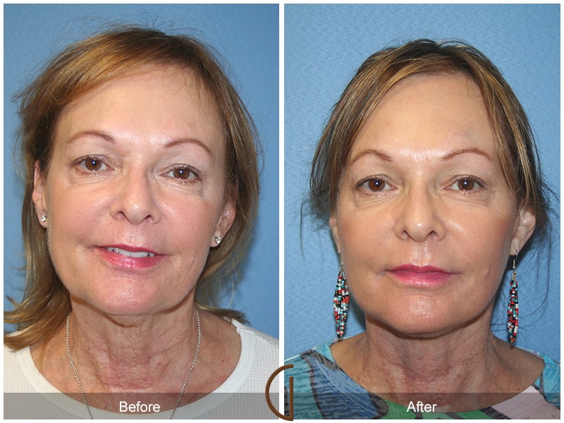 Facelift Newport Beach Image