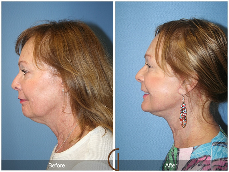 Facelift Newport Beach Image
