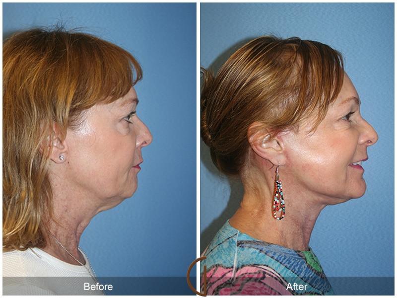 Facelift Newport Beach Image