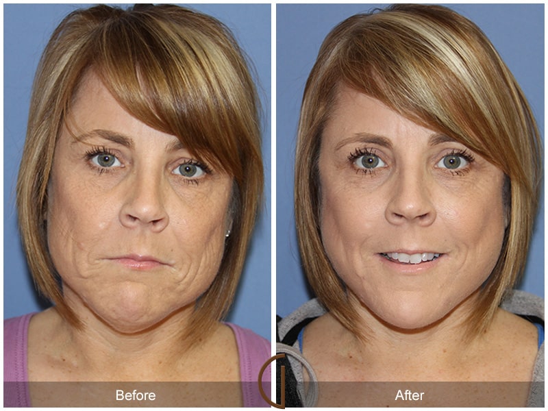 Facelift Aliso Viejo CA 108 Image