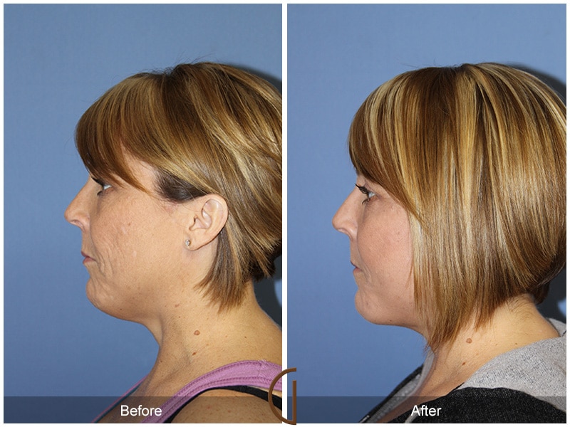 Facelift Aliso Viejo CA 108 Image