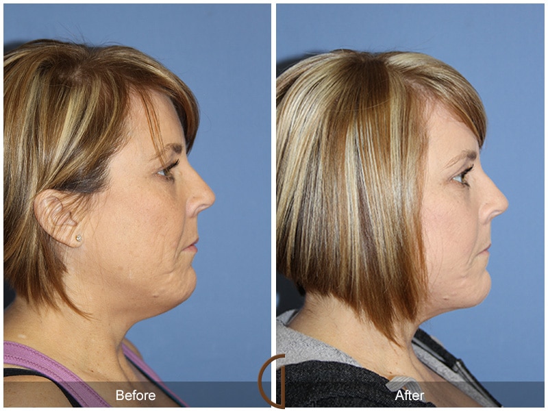 Facelift Aliso Viejo CA 108 Image