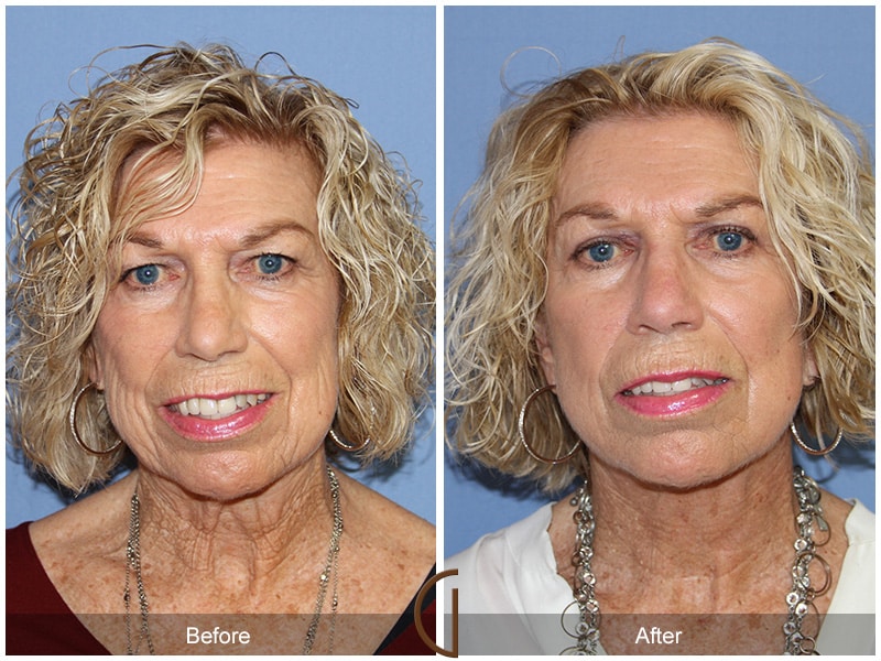 Facelift Laguna Beach CA 110 Image