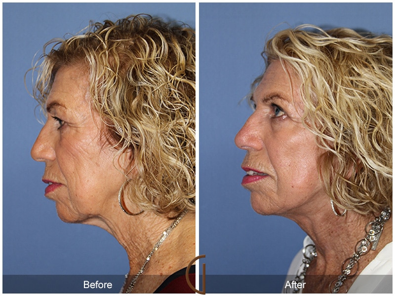 Facelift Laguna Beach CA 110 Image