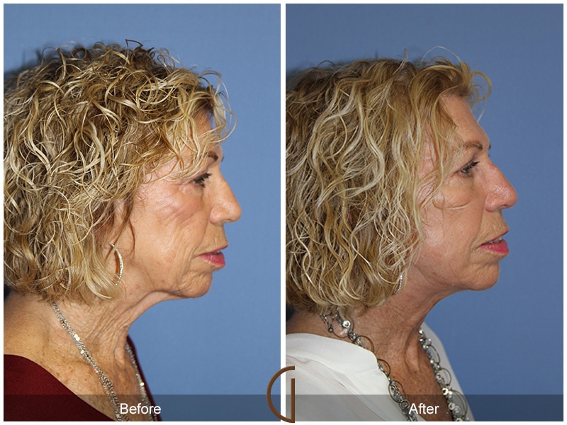 Facelift Laguna Beach CA 110 Image