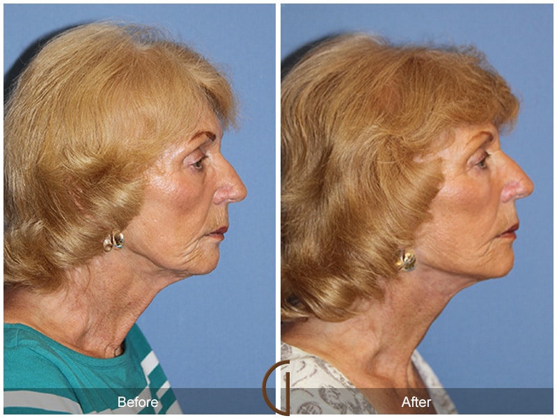 Facelift Irvine CA 112 Image