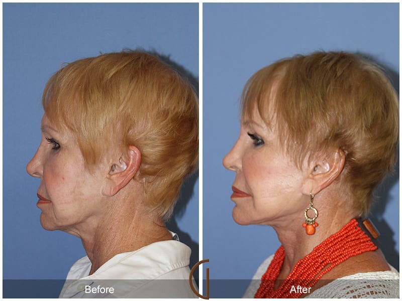 Facial Fat Grafting Huntington Beach CA 12 Image