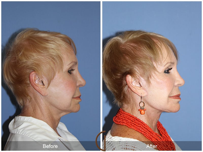 Facial Fat Grafting Huntington Beach CA 12 Image