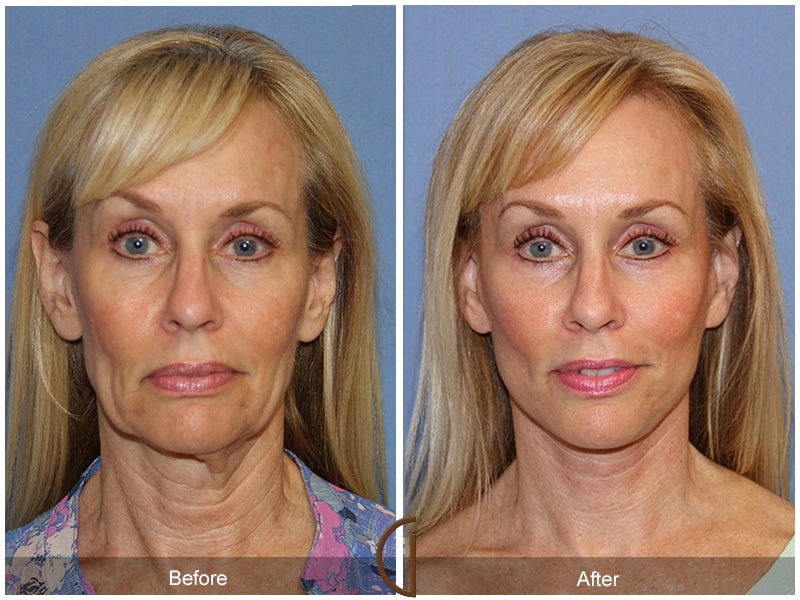 Natural Results from a Facelift are Possible Image