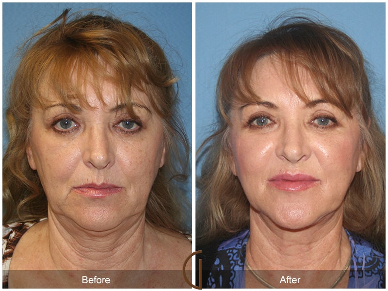 Facelift Los Angeles CA 12 Image