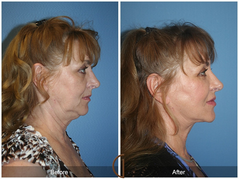 Facelift Los Angeles CA 12 Image