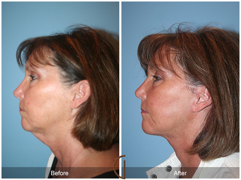 Facelift San Marino CA 15 Image