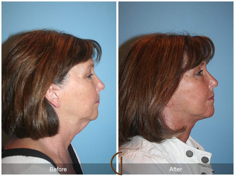 Facelift San Marino CA 15 Image