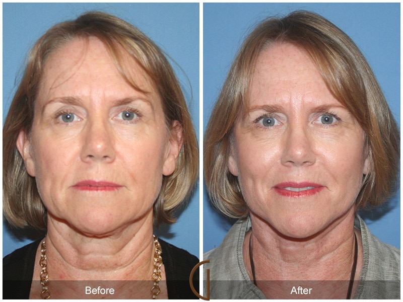 Facelift Agoura Hills CA 16 Image