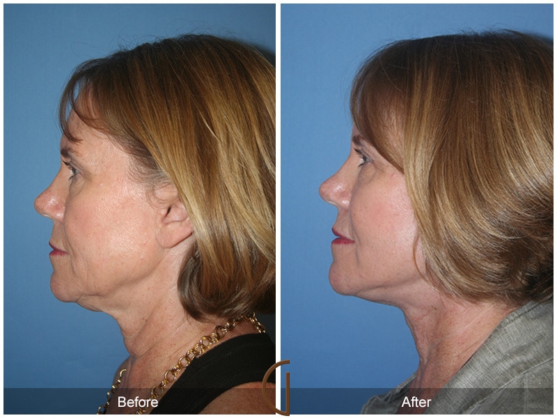 Facelift Agoura Hills CA 16 Image