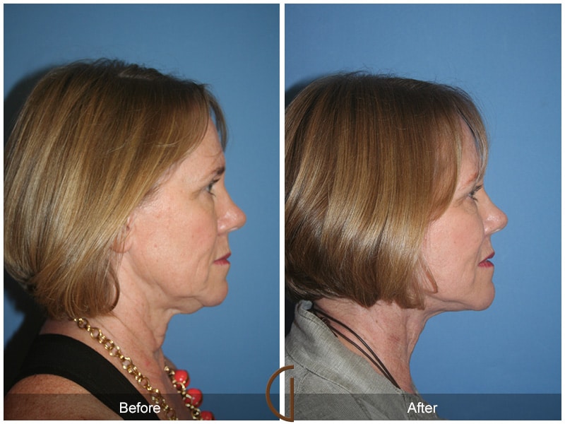 Facelift Agoura Hills CA 16 Image