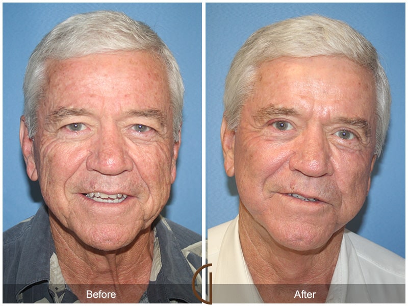 Facelift Cerritos CA Image