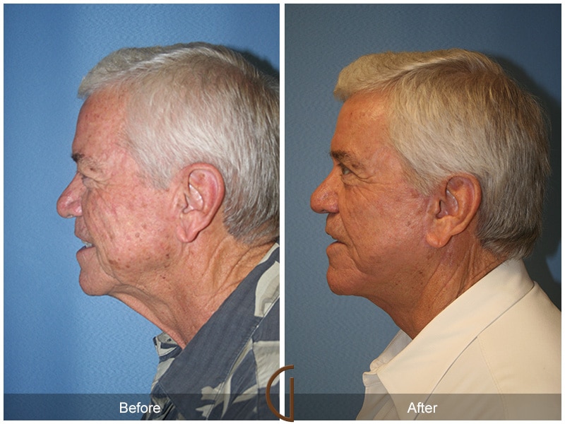 Facelift Cerritos CA Image